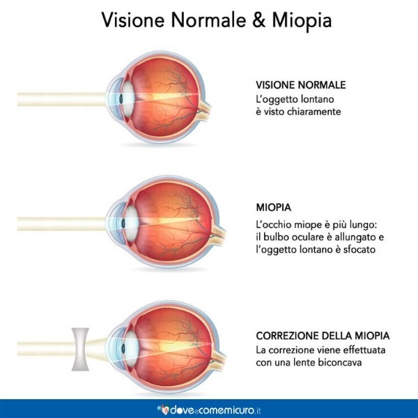 confronto-visione-normale-visione-occhio-miope