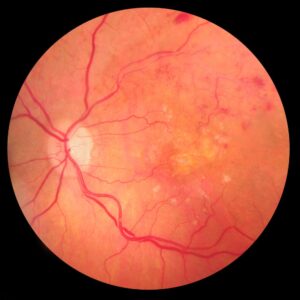 fondo dell’occhio con retinopatia ipertensiva di 3° | ipertensione arteriosa