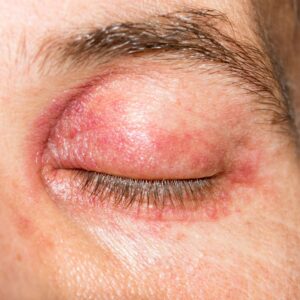 irritazione palpebre rosacea